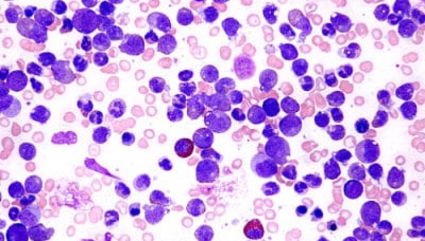 chronic-myeloid-leukemia_opt